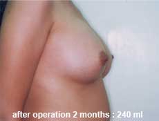 plastic-surgery-breast-augmentation 